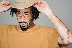 vitiligo